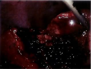 ruptured gall bladder